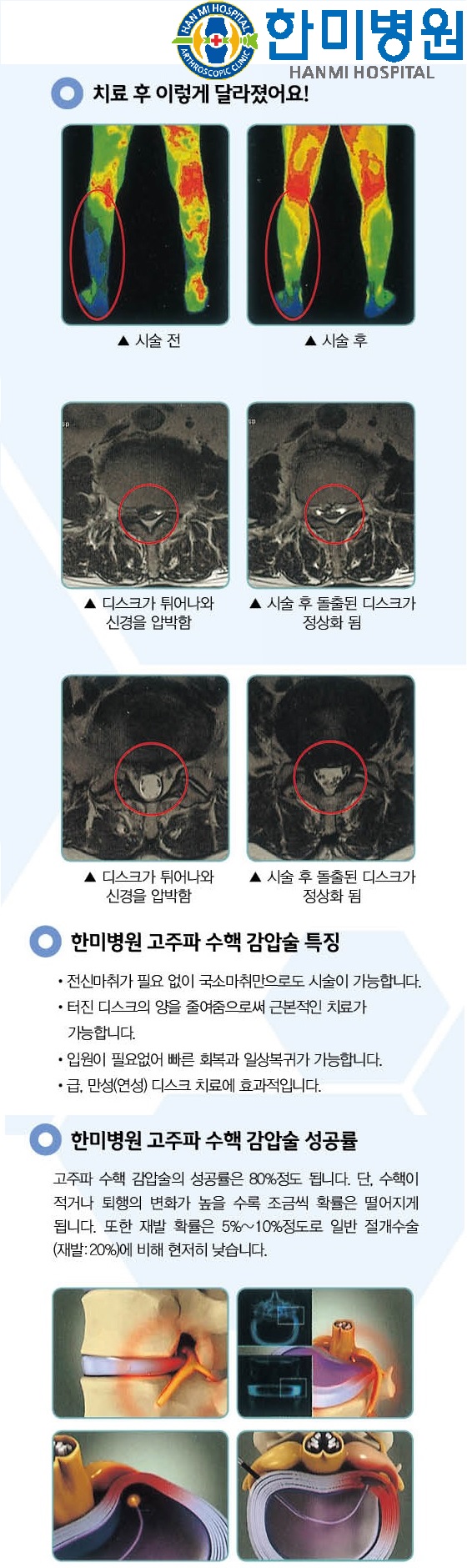 고주파수핵감압술 홈피용2.jpg