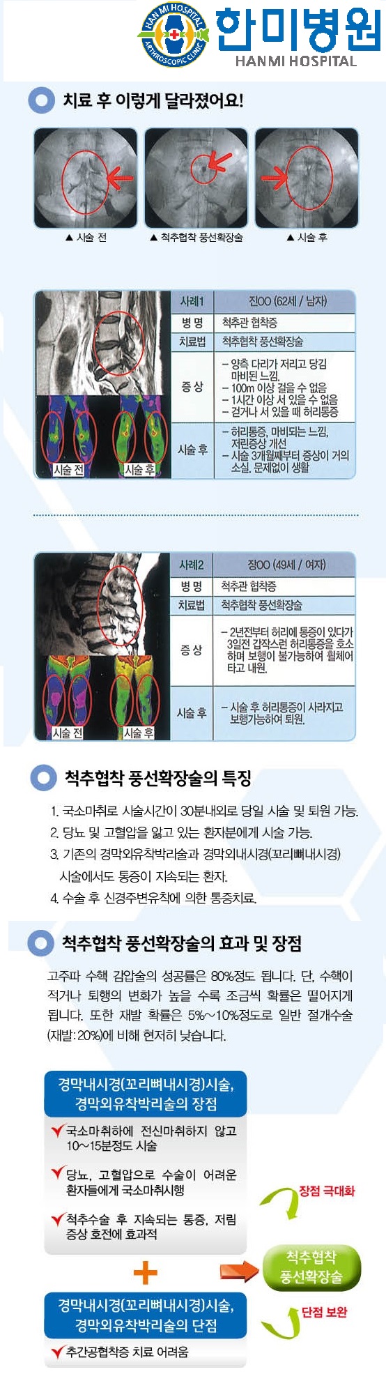 척추협착 풍선확장 홈피용 2.jpg