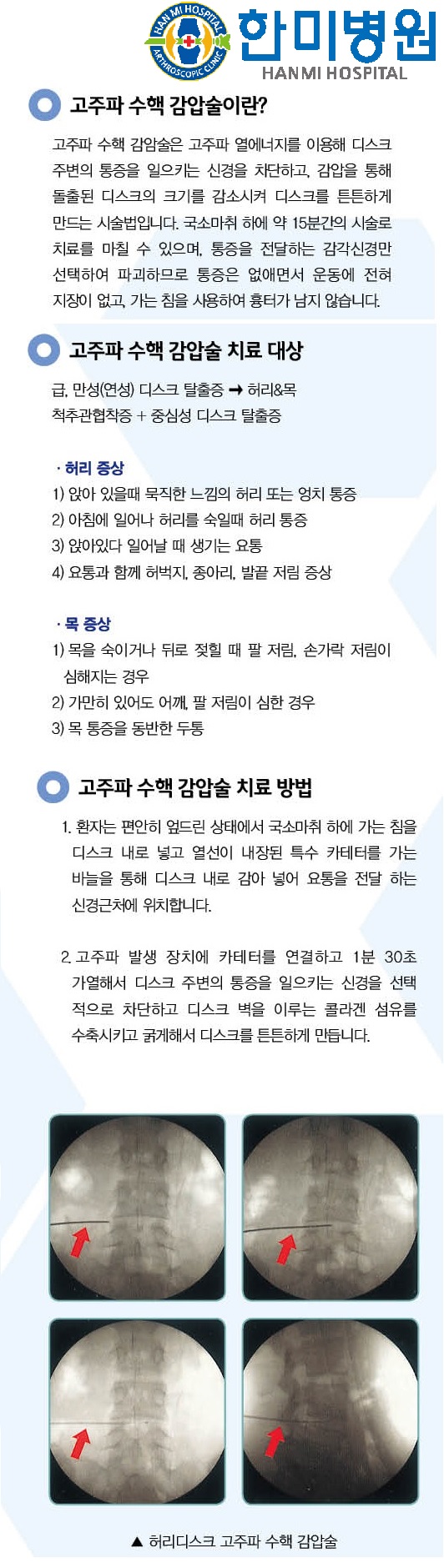 고주파수핵감압술 홈피용1.jpg