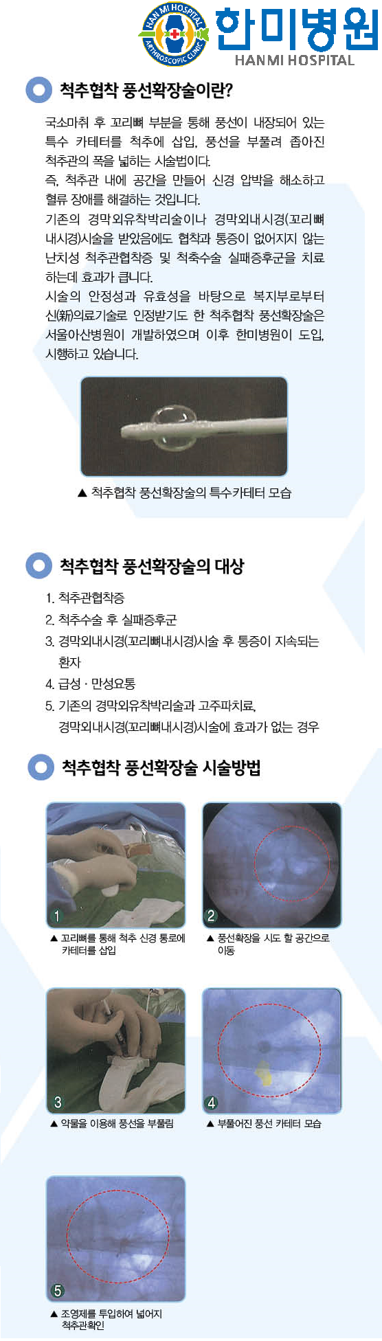 척추협착풍선확장술 홈피용1.png