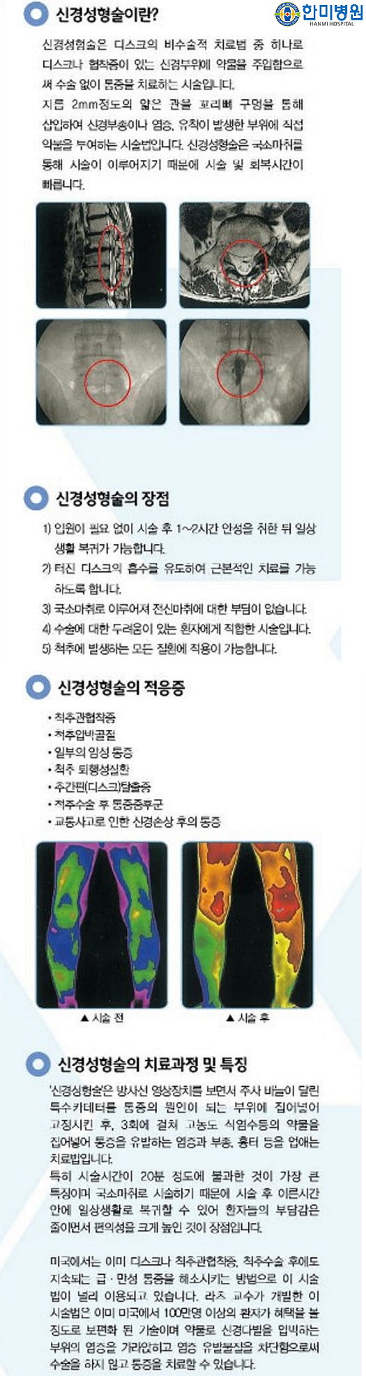 경막외 신경성형술 홈피용 1.png